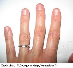 Taille du scléroderme par rapport à une main