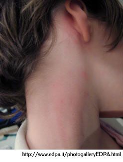 Réaction allergique aux acariens